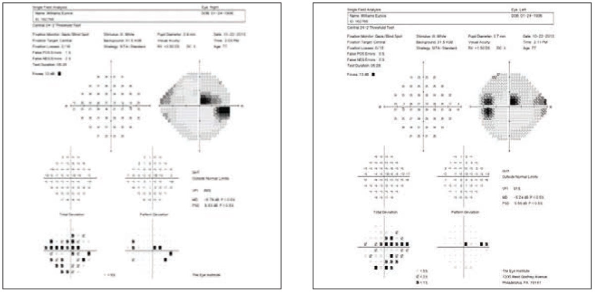 The homonymous field defect leads one to consider a differential diagnosis path that may or may not be supported by the exam findings and OCT results.