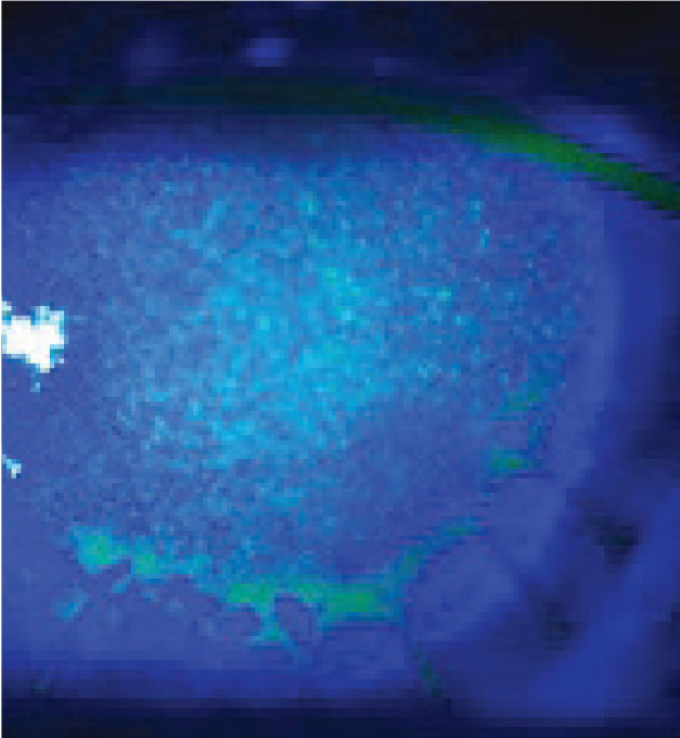 Fig 2. Corneal edema may signal graft rejection post-PK.