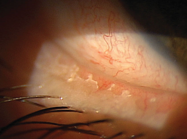 Bacterial biofilm on the lid margin contributes to MGD and, hence, dry eye. BlephEx treatment—the top choice for office procedures in our survey—removes it. Image courtesy of Paul Karpecki, OD.