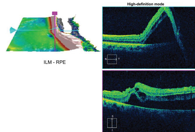 Fig. 2. How do you interpret this OCT scan through the macula?