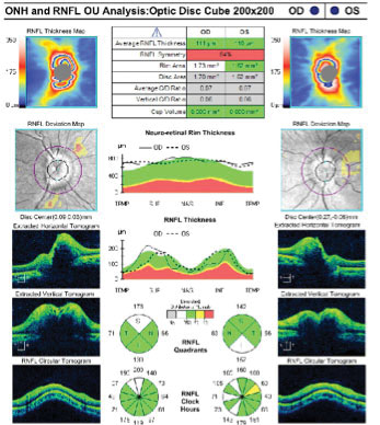 Fig. 3. OCT retinal nerve fiber layer analysis at the initial visit revealed slightly increased values, suggesting possible disc edema.