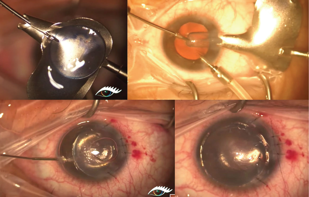 Top left: A 9.0mm donor graft is loaded into the plate of the glide with the endothelium side up. Top right: The donor tissue is folded up like a taco and pulled through the funnel-shaped portion of the glide, then pulled through the temporal incision. Bottom left: After the graft has been successfully inserted into the anterior chamber, it is unfolded in the recipient anterior chamber with balanced saline solution and/or an air bubble. Bottom right: The donor button maintains apposition with the host cornea through use of an air bubble, giving time for the endothelial pumps to aid in donor-host tissue binding.