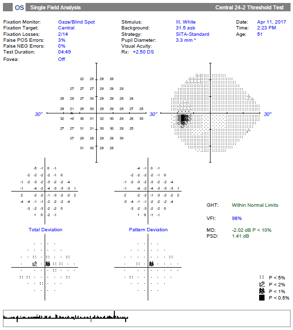 The 24-2 SITA Standard reveals a single significant superior paracentral defect and a “within normal limits” message on the GHT. Although the point is statistically significant, it might be overlooked.