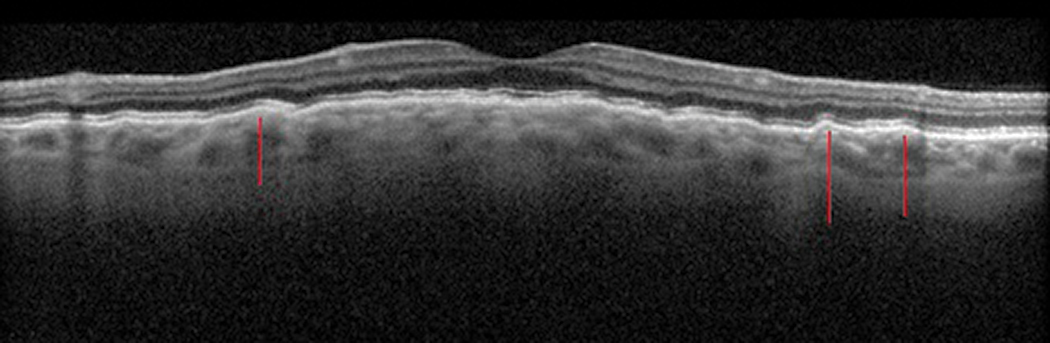 Fig. 5. Choroidal folds causing sub-RPE undulations (red lines).