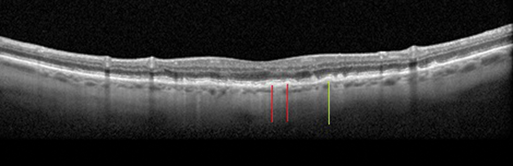 Fig. 6. Hard drusen (green line) with mild RPE mottling (red lines).