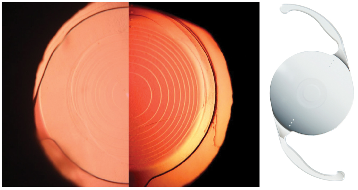 A successful comanagement relationship is one where ODs and MDs are able to rely on each other so that they’re splitting rather than duplicating the work. For instance, the optometrist should understand and be able to articulate the differences between newer IOLs to lead the patient discussion about options. Left to right: PanOptix (Alcon), Symfony (Johnson & Johnson Vision) and Vivity (Alcon) lenses.