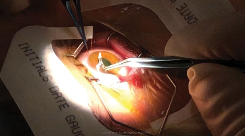 An ICRS is placed into an intrastromal channel immediately after undergoing CXL. Note the riboflavin-induced yellow hue of the cornea.