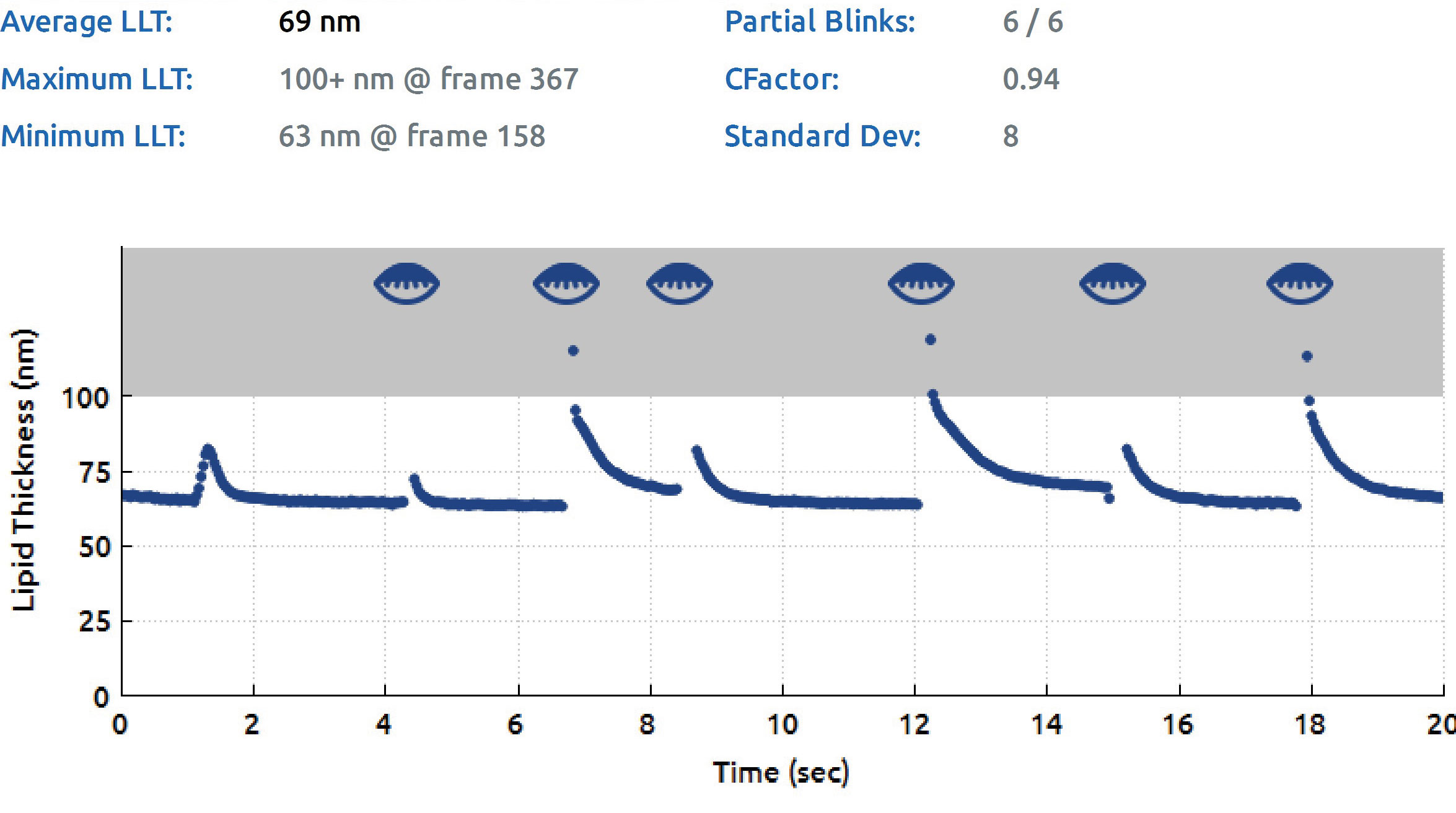 LipiView II Surface Interferometer lipid layer thickness (LLT) and blink rate assessment. Results show reduced average LLT and high partial blink rate contributing to meibomian gland dysfunction.