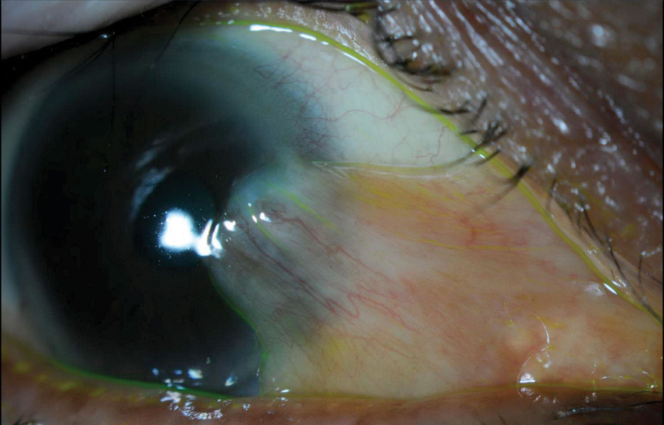 Slit lamp photo demonstrating large, nasal, mildly inflamed pterygium and inferior lid scalloping secondary to MGD. In addition to managing the MGD-associated DED, we referred this patient for pterygium removal due to persistent ocular irritation.