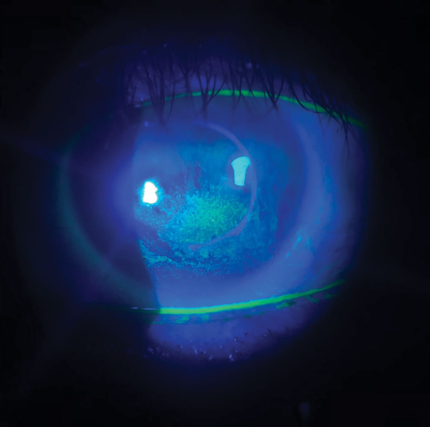 Slit lamp image showing diffuse punctate epithelial fluorescein staining secondary to lagophthalmos. Superior to the staining, the tear film has also “broken” as visualized during TBUT testing with fluorescein dye.