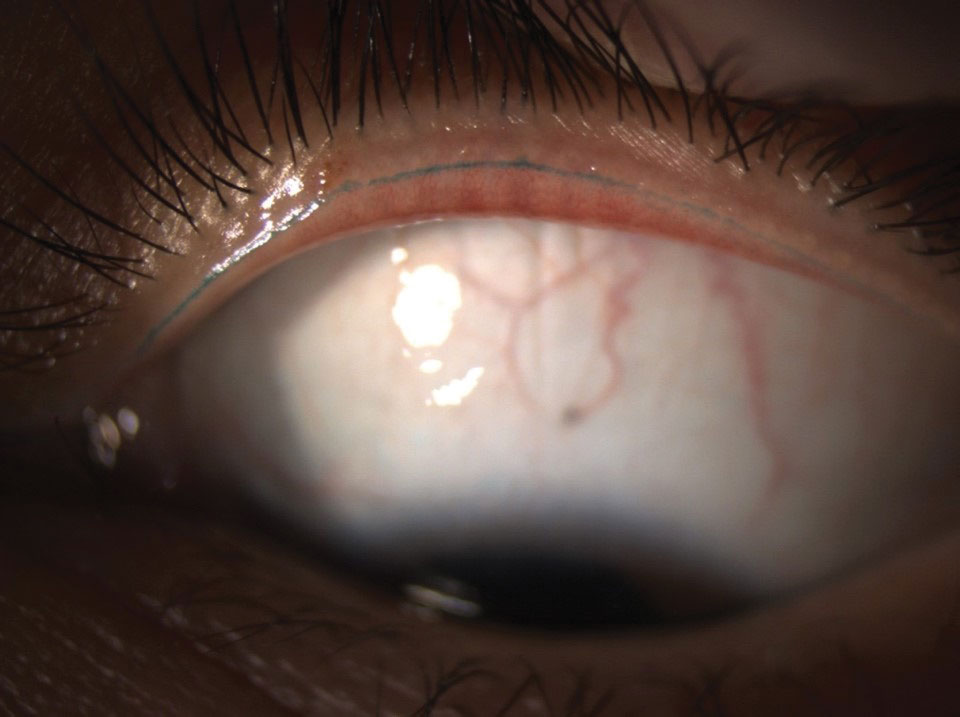 Slit lamp photo with the line of Marx visualized with lissamine green stain. Lid wiper epitheliopathy, when present, is visible posterior to the line of Marx.