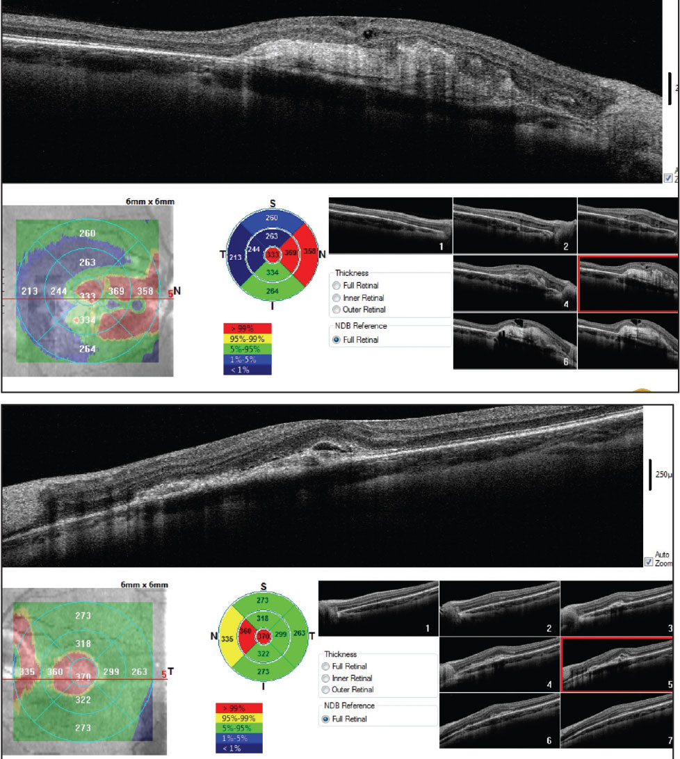 This is the OCT through the macula of the right (on top) and left eyes.