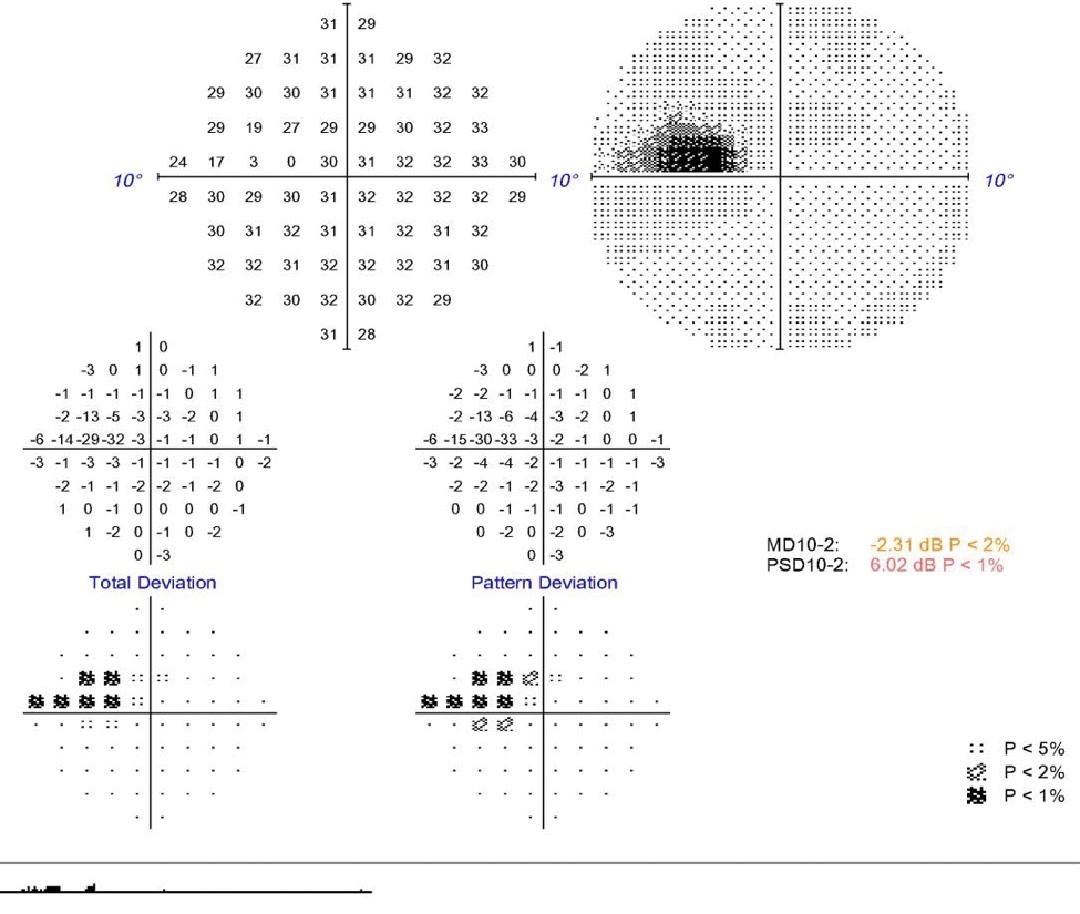 This 10-2 visual field displays our patient’s paracentral scotoma. 