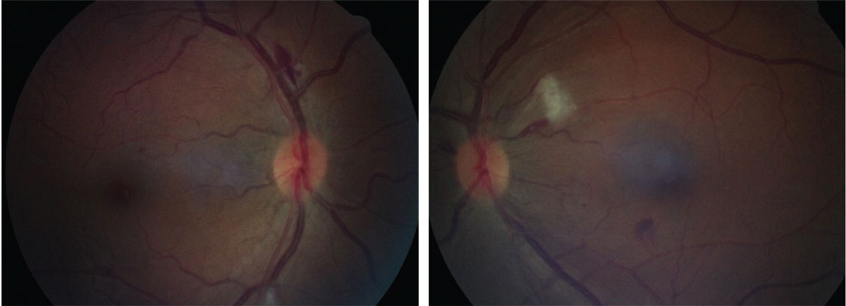 Dilated exam revealed the presentations shown here. How might they relate to the case history she described?