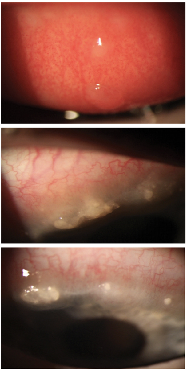 VKC with two giant cobblestone papillae and extensive Horner-Trantas dots in a nine-year-old white male. The patient responded well to treatment with topical steroids, but limbal scarring did result upon resolution.