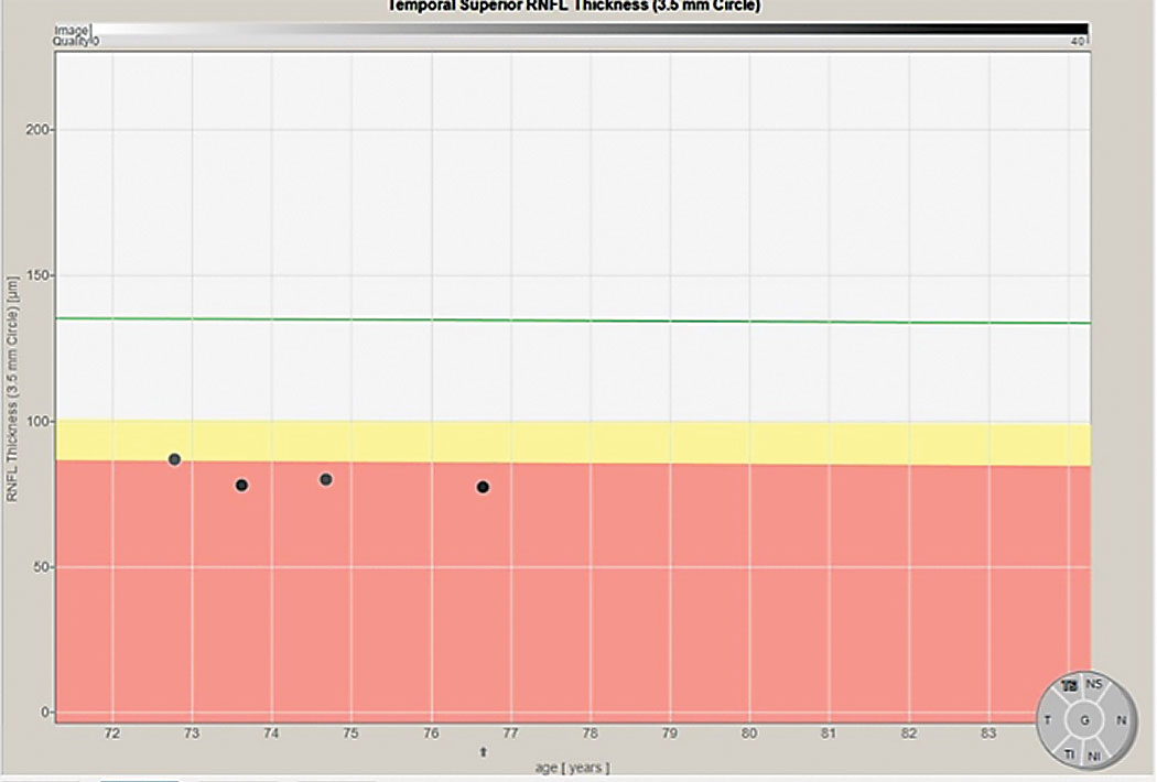 Progression analysis of the superior temporal sector of the RNFL using a 3.5mm scan, showing a subtle decline over a four-year period. This is suggestive of subtle progression.