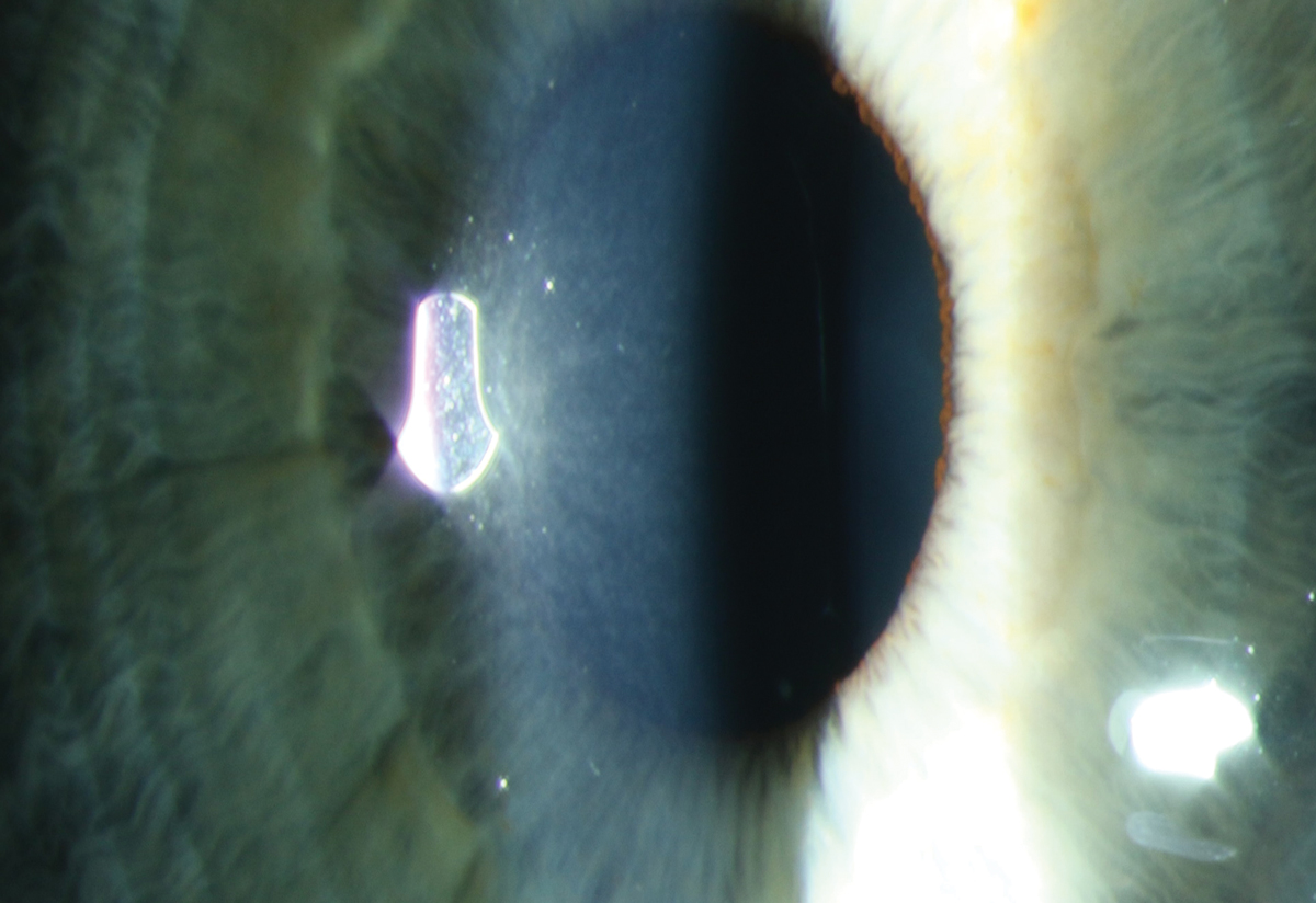 Fig. 2. Early subepithelial refractile deposits in a patient on macrolide therapy for chronic obstructive pulmonary disease.