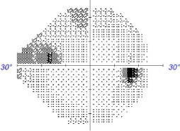 The PanoMap feature on the Zeiss Cirrus OCT (top) exhibits thinning of both the retinal nerve fiber layer and ganglion cell layer-inner plexiform layer complex with a corresponding visual field result (bottom) showing a superior nasal step defect. 