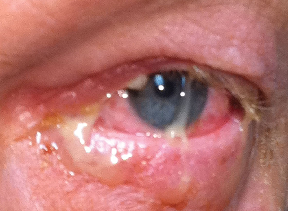 Mucopurulent discharge characteristic of bacterial conjunctivitis.