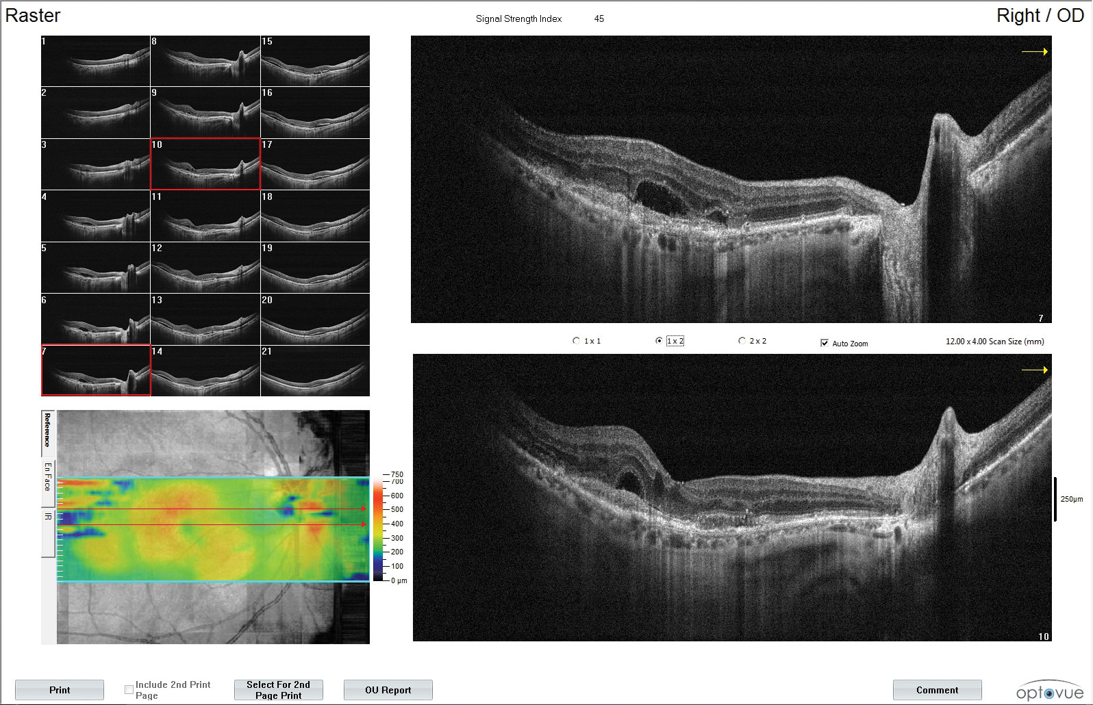 ARCHWAY marks a change in anti-VEGF treatment as it focuses on how the therapeutic is delivered, as opposed to the drug itself.