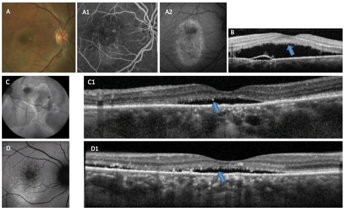 Get Serious About Central Serous Chorioretinopathy