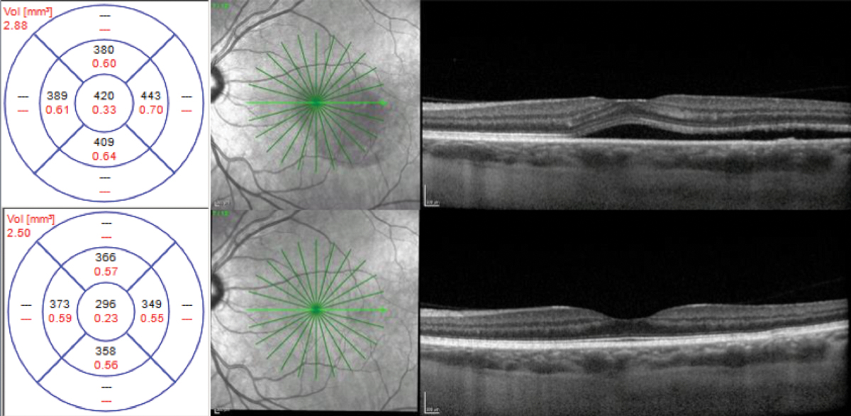 Fig. 5. Acute case of CSCR (top). Resolution at one year without treatment (bottom).