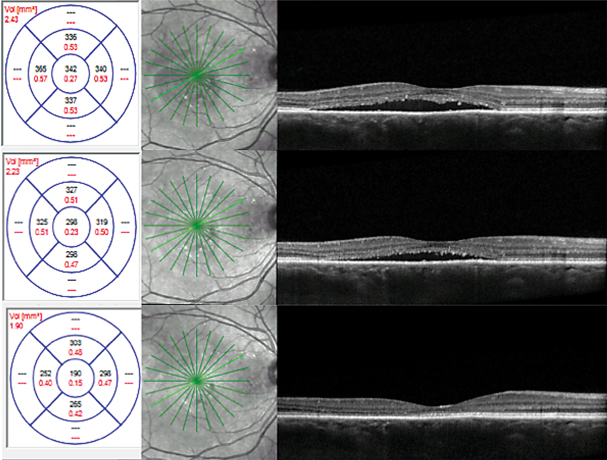 Fig. 6. CFT was 342μm at initial presentation (top), 298μm after one month of treatment with eplerenone (middle) and 190μm after two months (bottom).