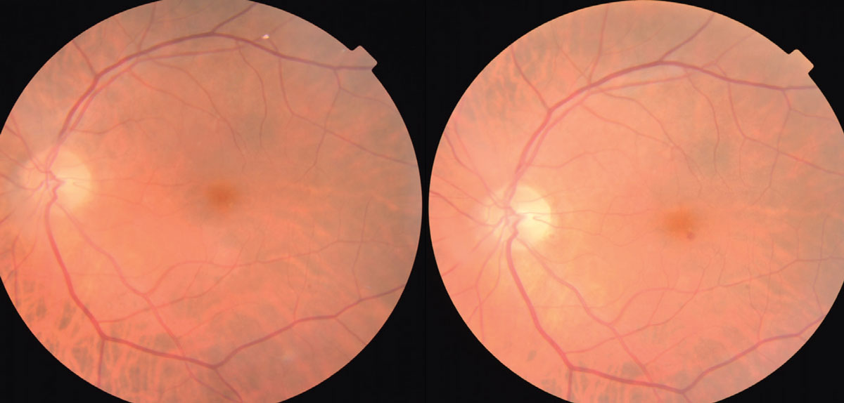 Fig. 1. The photo on the left shows a Hollenhorst cholesterol plaque within the superior-temporal vascular arcade. At follow-up three months later, the plaque is not present.