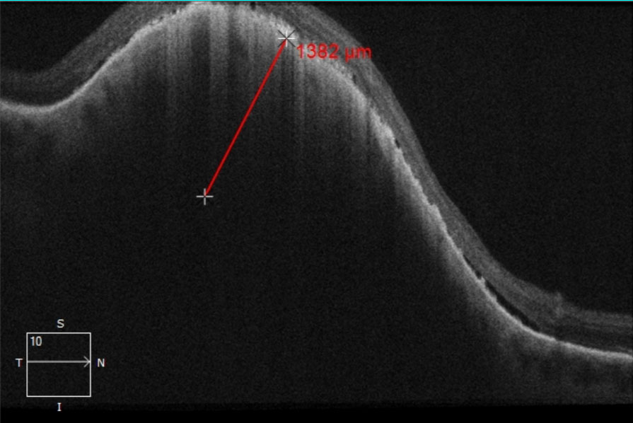 Figure 2: OCT raster image through the pigmented choroidal tumor.  The thickness of the tumor was measured to be approximately 1,382 micrometers.  Presence of subretinal fluid was noted along the tumor margins and more evident on the posterior aspect.  Additionally, diffuse subretinal hyperreflective pigment deposition causing posterior shadowing within the tumor below was notable, and likely signified lipofuscin.