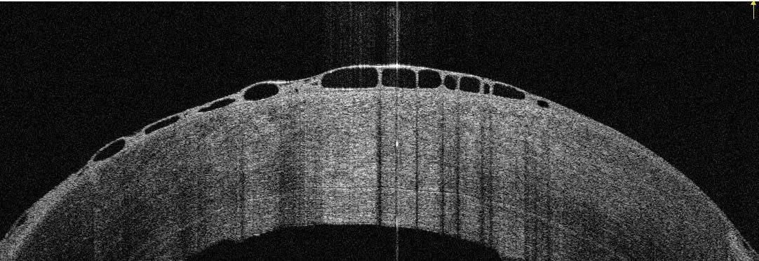 Honeycomb edema in a patient treated with Rhopressa who underwent a failed DSAEK.