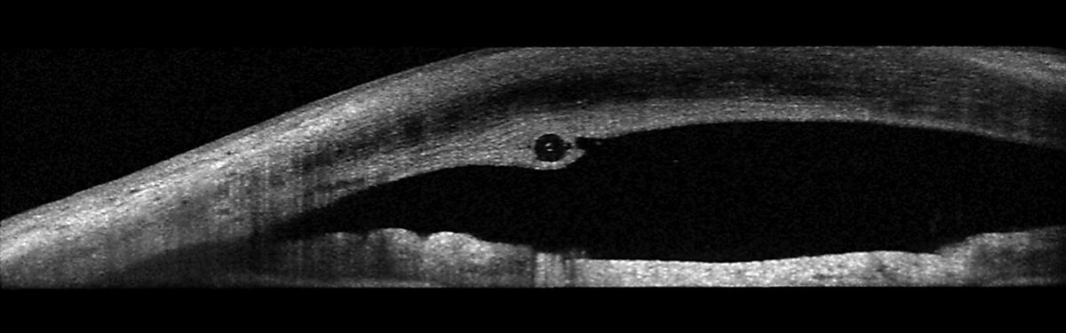 The stent was improperly placed. Here, it runs through the cornea, anterior to the anterior chamber angle.