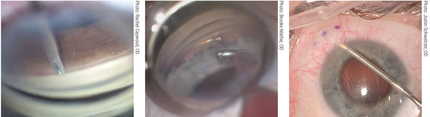 A stent for all occasions. Left to right: iStent Inject (Glaukos), Hydrus Microstent (Ivantis), Xen gel stent (Allergan). ODs should be well-versed in the uses of these and other options to play a part—perhaps a decisive one­—in the timing and selection of a MIGS procedure.