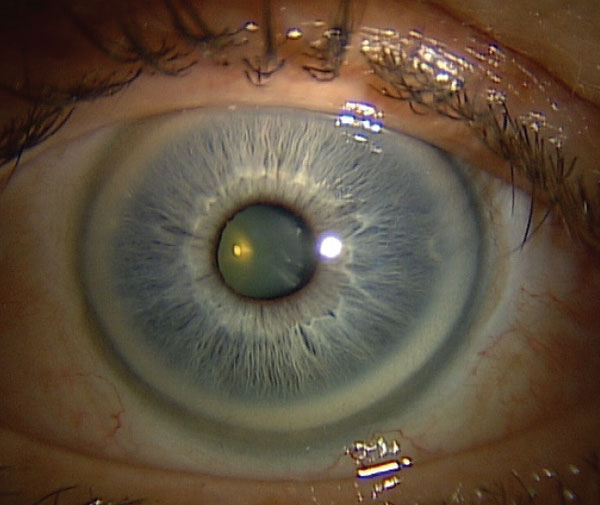 Age-related deposition of cholesterol and other lipids in the stroma occurs in response to increased permeability of the limbal blood vessels. 