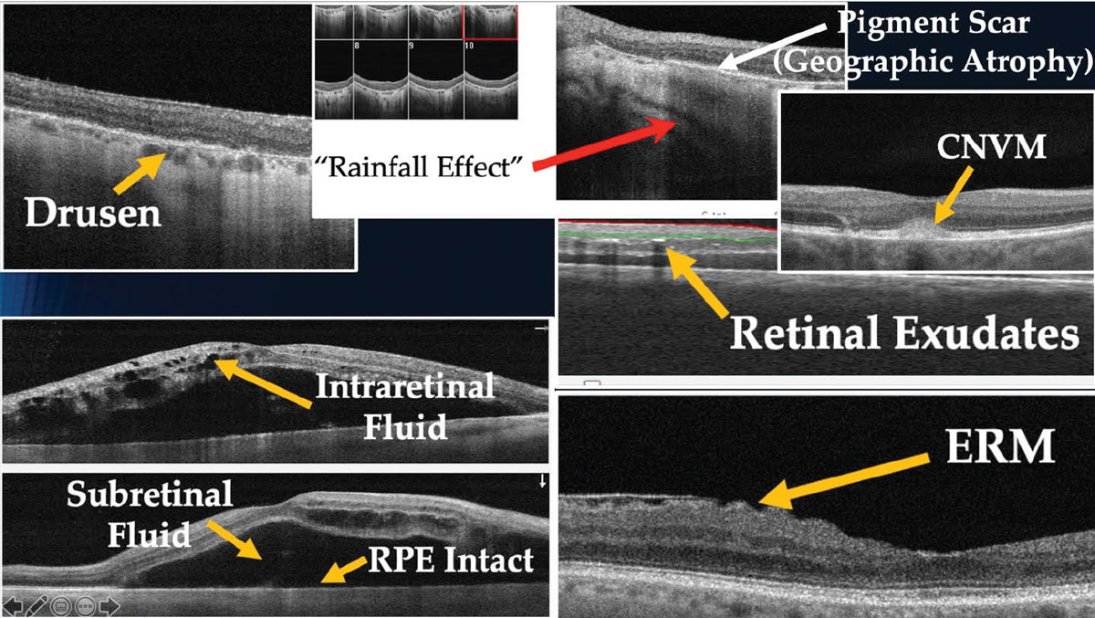 Fig. 1. Characteristics of ocular abnormalities on OCT images. 