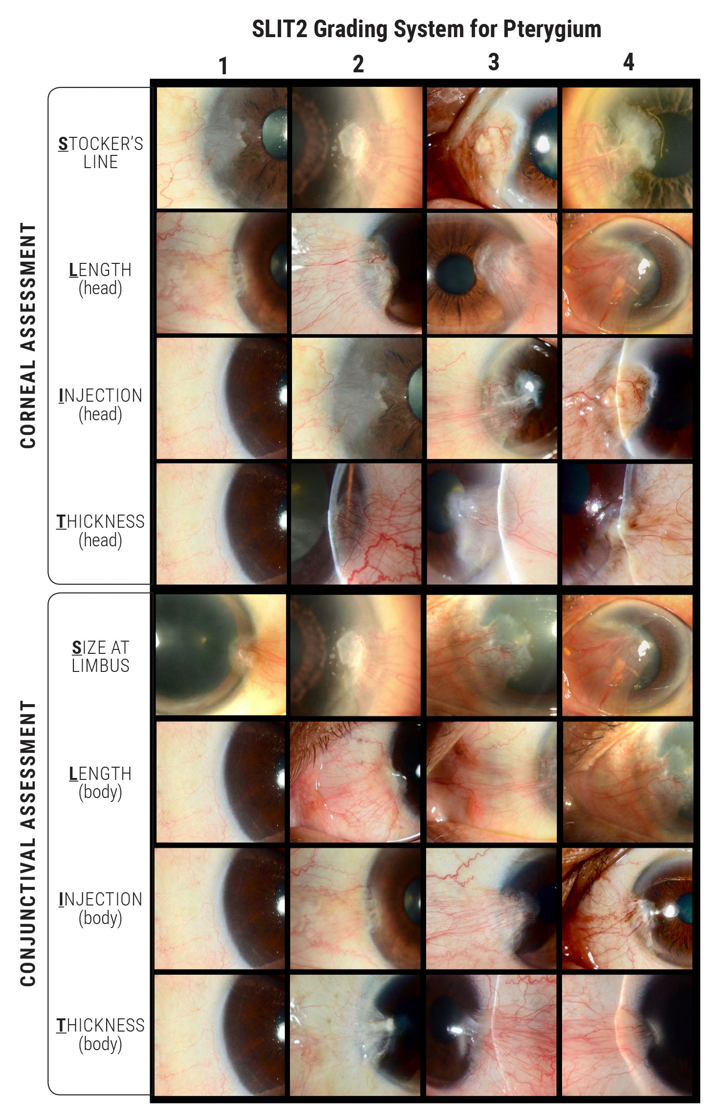 SLIT2 Grading System for Pterygium.