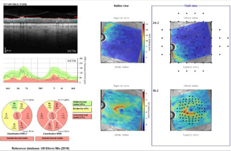 The Hood report of the left eye, with concordance of the neuroretinal rim and perioptic RNFL damage.