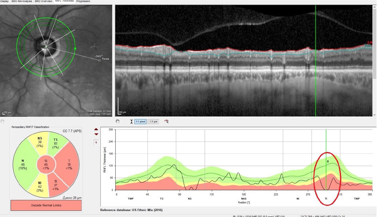 Efforts to stabilize IOP—rather than just lower it—may mitigate RNFL thinning, researchers argue. Image courtesy of James Fanelli, OD. 