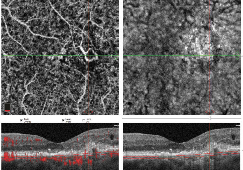 OCT-A can be used as an accurate tool for identifying nAMD patients, leading to more timely anti-VEGF treatment and better outcomes. Photo: Steven Ferrucci, OD, and Jay M. Haynie, OD. 