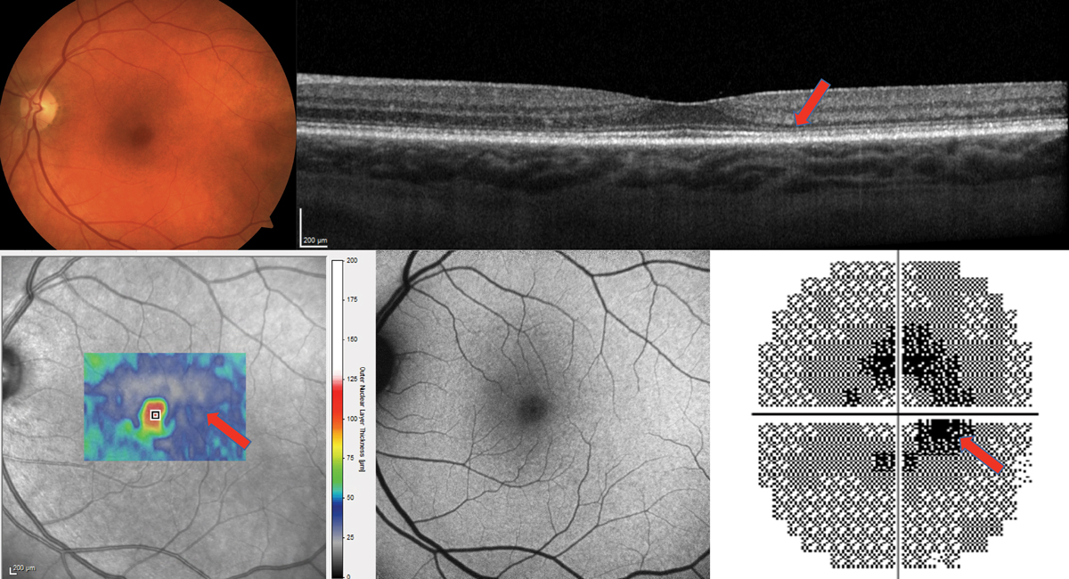 Fig. 5. The cross-section OCT shows a very thin outer nuclear layer, especially temporally (red arrow) but no frank loss of the photoreceptor integrity line. The thickness map of the ONL only also appears very thin (bottom left). The FAF is essentially normal. The 10-2 visual field shows a ring scotoma most dense nasally and is highly suggestive of plaquenil maculopathy. Findings were bilateral.