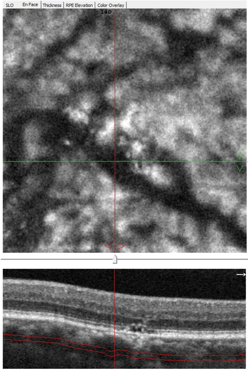 Fig. 7. En face OCT-A allows viewing at different depths and can highlight pathologically dilated choroidal vessels (pachyvessels), which typically show an abrupt termination vs. gradually tapering.