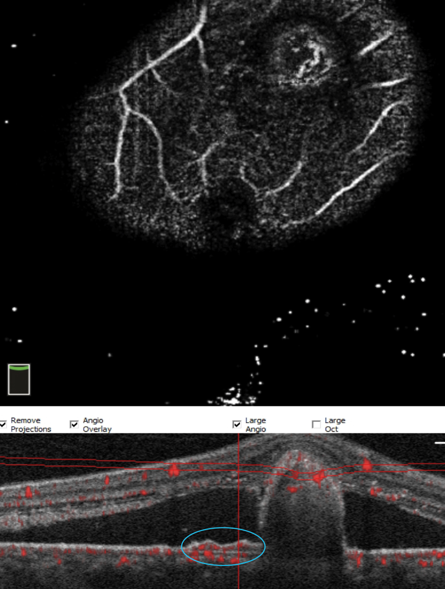 Fig. 11. With significant pathology, OCT-A sometimes has trouble segmenting. Here, manual manipulation of the scan identifies the polyp. These represent further growth of the BVN under the shallow RPE detachment (double layer sign, blue circle) and continuing to proliferate on the undersurface of the RPE detachment.