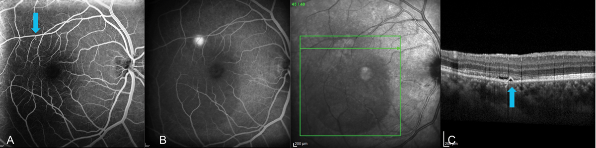 Fig. 8. Multimodal imaging of a 34-year-old male with CSC. (A) FA in the early phase highlights the triangular-shaped PED found on spectral-domain OCT (blue arrows). (B) Late-phase FA shows leakage from this area, confirming an RPE microrip. Note the centrally diminished choroidal fluorescence in late phase due to the large serous RD. (C) EDI SD-OCT (Spectralis, Heidelberg) showed choroidal thickness of about 500µm with a triangular-shaped PED and neurosensory RD, the latter of which increased as it got closer to the fovea. Multimodal testing altered the initial treatment plan of observation to one of referral for laser treatment. FA allows for visualization of the area of leakage that can be targeted with laser treatment. This cannot be seen with OCT or OCT-A.