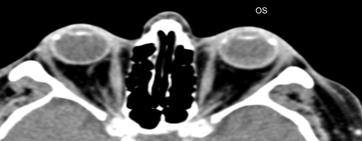 Fig. 14. Previously performed CT scan shows normal orbit and globe OU.