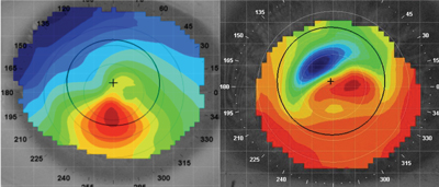 Keratoconus patients who don't wear contacts are likely to experience a similar level of endothelial cell changes regardless of disease stage. 