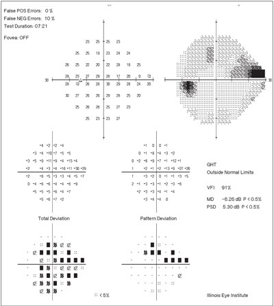 Those with VI have a higher risk of dementia. Image courtesy of Michael Chaglasian, OD. 