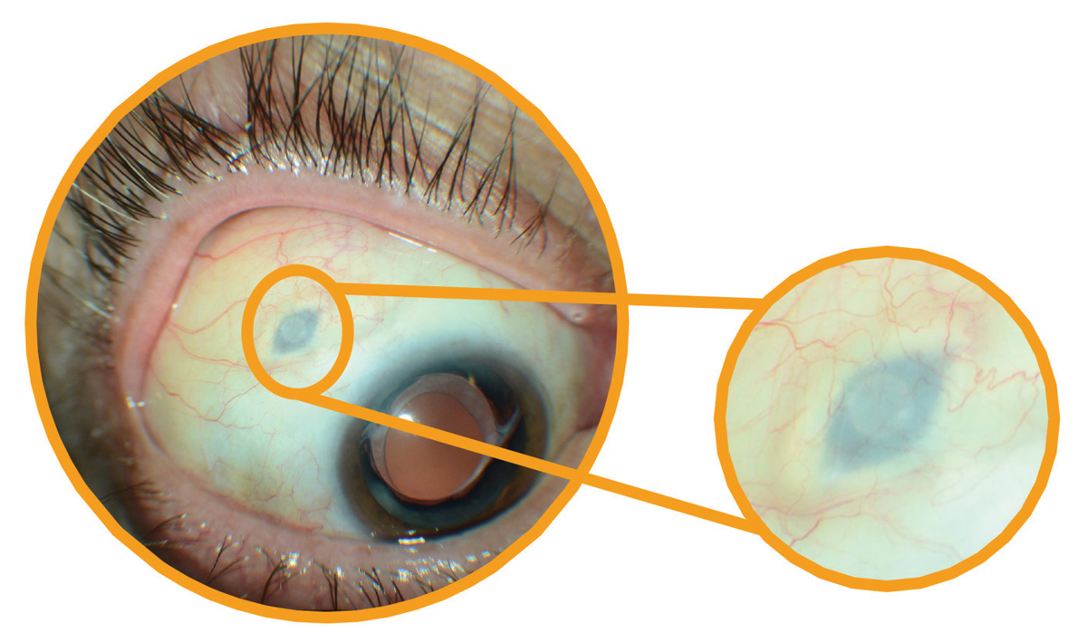 Archway is the first successful Phase III trial of a continuous delivery system for a biologic agent into the vitreous. Photo: Anat Loewenstein, MD. 