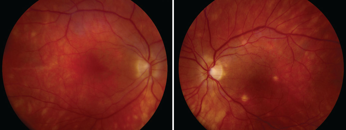 COVID-19 infection rates and COVID-19 hospitalization rates were higher among those with noninfectious than infectious uveitis. 