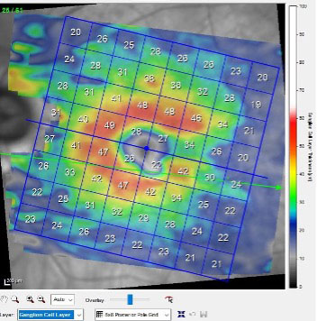 While the patient’s neuroretinal rim shows significant damage, the macular ganglion cell layer has remained reasonably healthy.