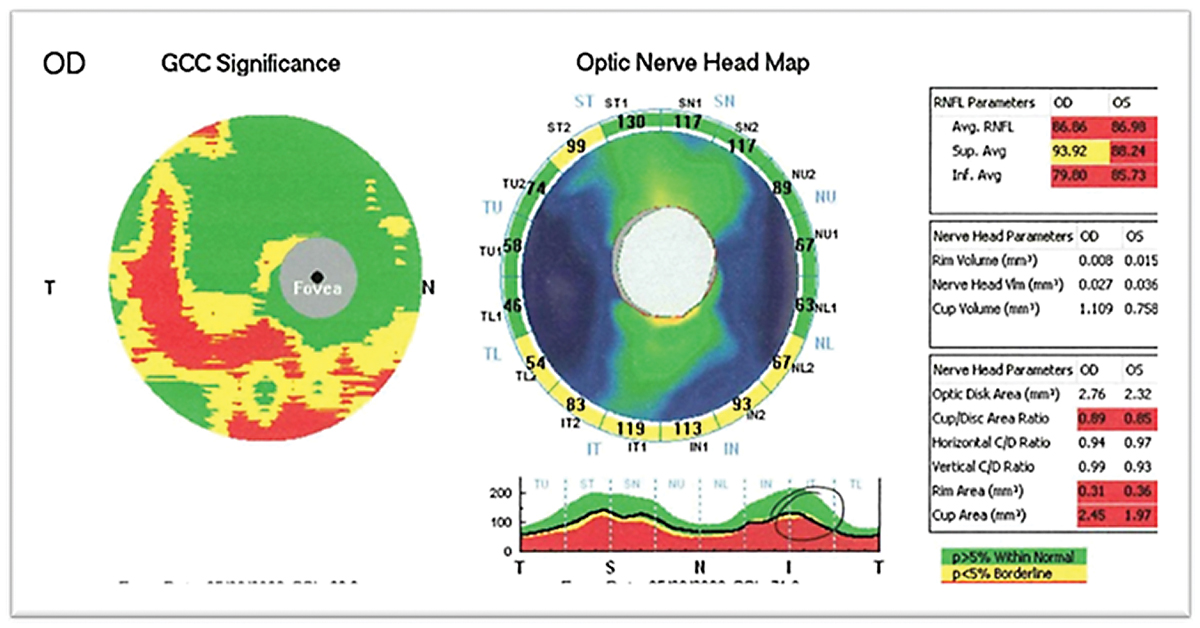 Fig. 2. Patient’s OCT OD demonstrates large ratio cupping with inferior thinning of the RNFL and corresponding GCC consistent with glaucomatous optic nerve atrophy.