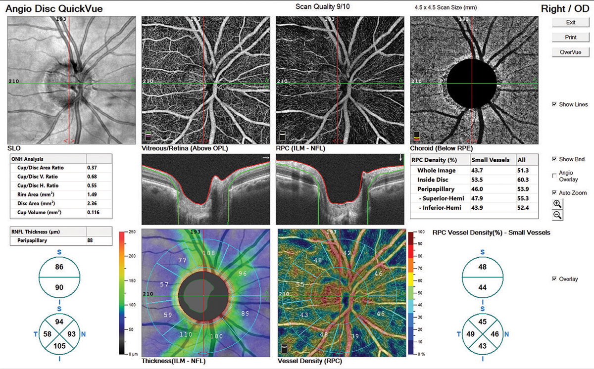 For patients in the sample, vessel density was the only structural parameter to correlate with visual acuity. Photo: Ryan Schott, OD.